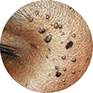 results fibormas