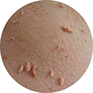results skin tags