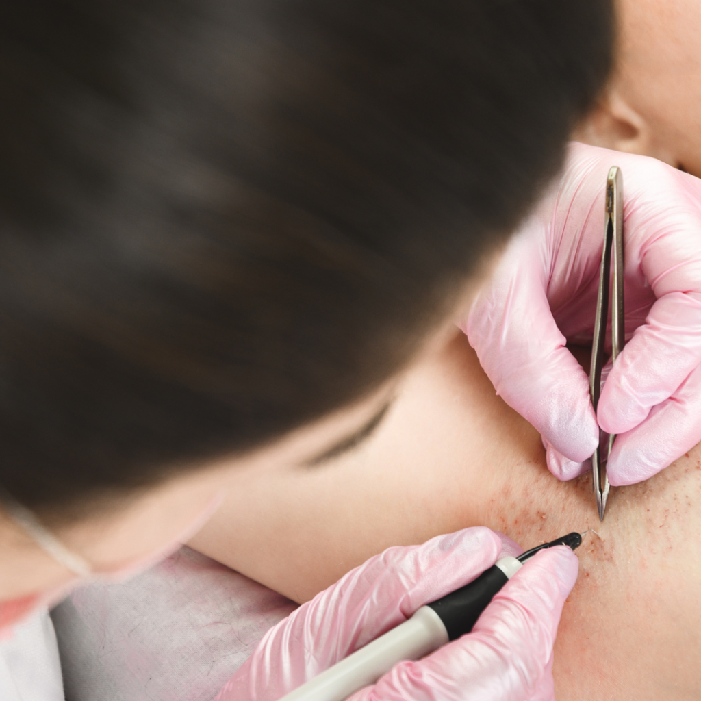 electrolysis clearwater fl